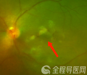 徐州一院刘海洋团队诊治一例疑难眼病患者