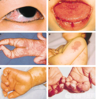 徐州市儿童医院科普:孩子反复发热不退,可能是川崎病!