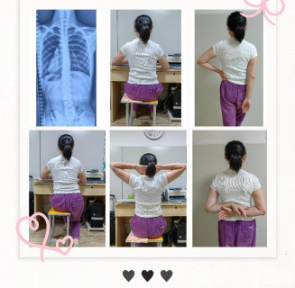 脊柱侧弯怎么办?徐州市儿童医院专家:日常生活姿态管理非常重要