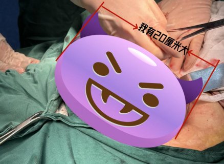 51岁女子肚子大以为是发胖 徐州妇幼保健院专家切除20cm巨大肿瘤