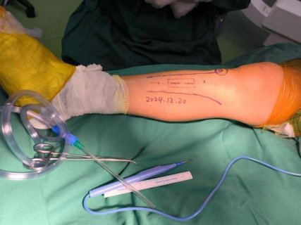 徐州市中医院骨科:横向骨搬运治疗糖尿病足 枯木逢春的保肢新技术