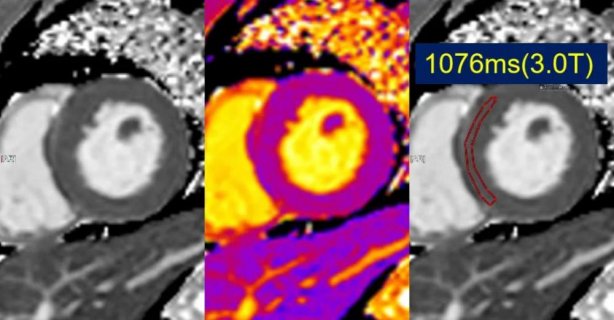 徐州市中心医院:心脏磁共振(CMR)助力心脏疾病精准诊断