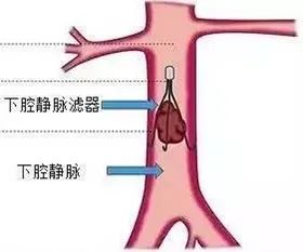 我院下腔静脉滤器置入术,撑起生命“保护伞”_皖康 安徽省皖南康复医院 芜湖市第五人民医院