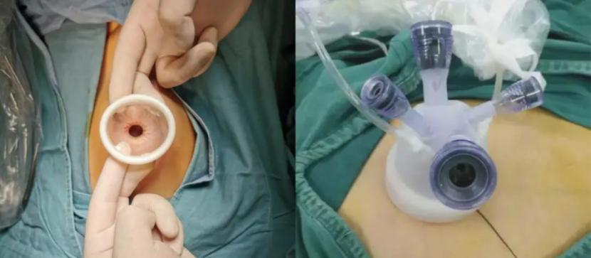 跳舞时突发卵巢囊肿蒂扭转 徐州市妇幼保健院经脐单孔减张缝合术施“隐形魔法”