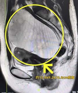 小囊肿放任不管变成13厘米癌瘤 徐州妇幼专家建议：每年一次妇科体检