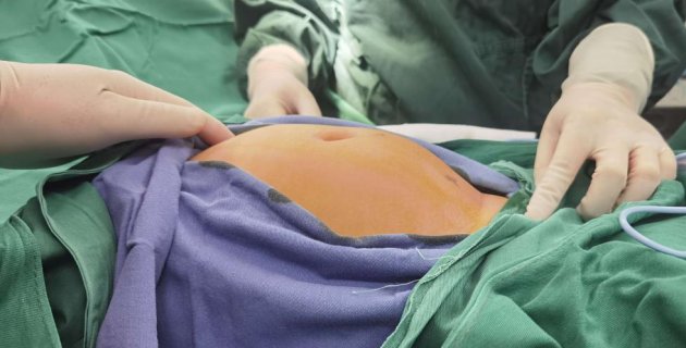 5岁女童盆腔巨大恶性畸胎瘤成功切除，徐州一院妇科团队春节坚守写大爱