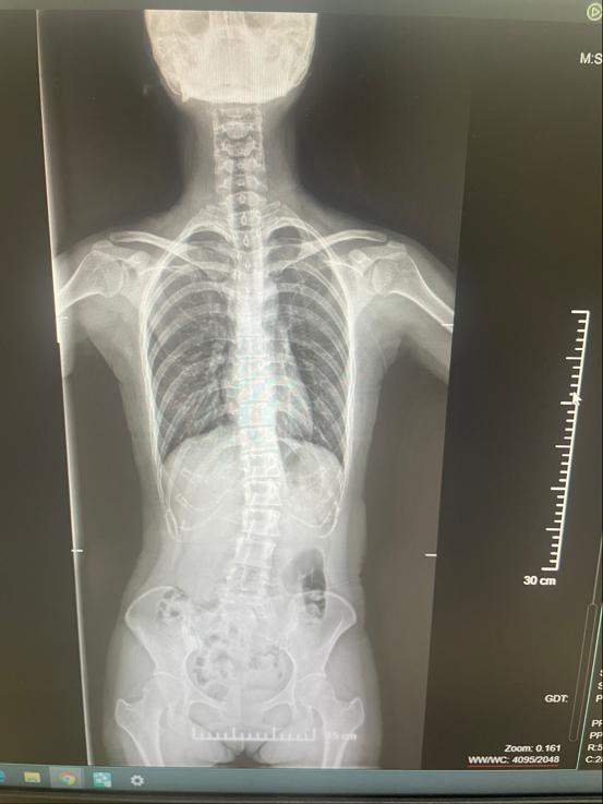 徐矿总医院脊柱侧弯产妇的分娩告白：遇良医 方知安心可贵