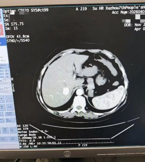 京徐协作 精准祛瘤——徐州七院成功开展复杂肝癌微波消融术