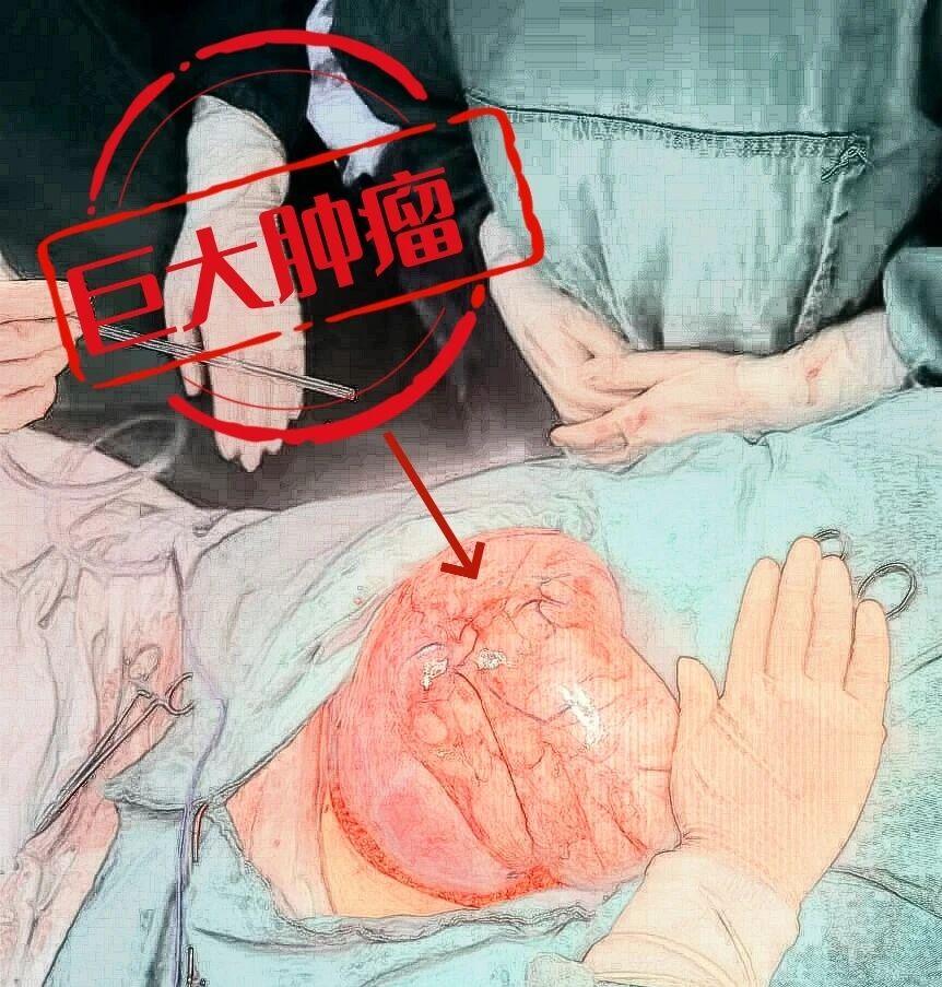 腹大如孕！体内藏着25cm“沉默巨瘤”，徐州妇科肿瘤专家团队精准“拆弹”