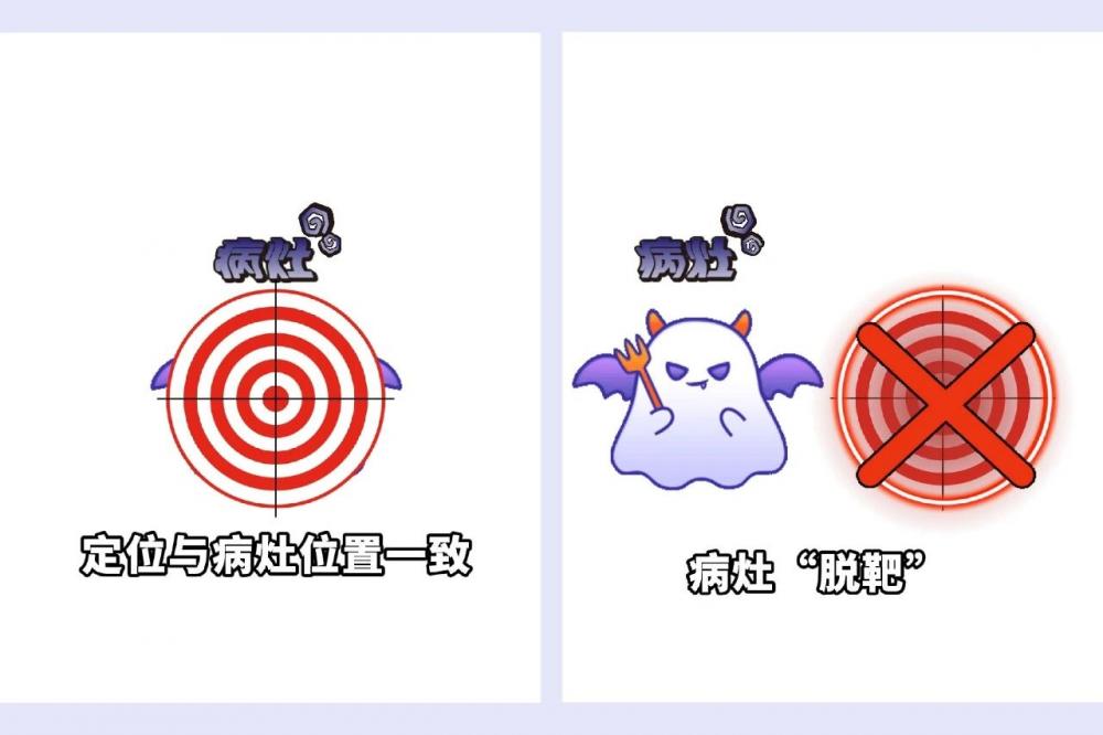 从“大概照”到“精准打”：徐矿总医院托姆刀为宫颈癌放疗点亮精准之路